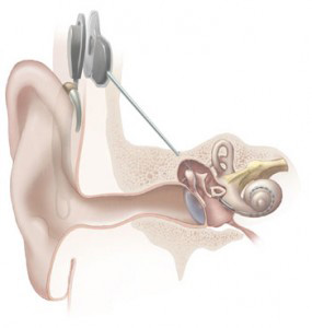 Cochlear implant study