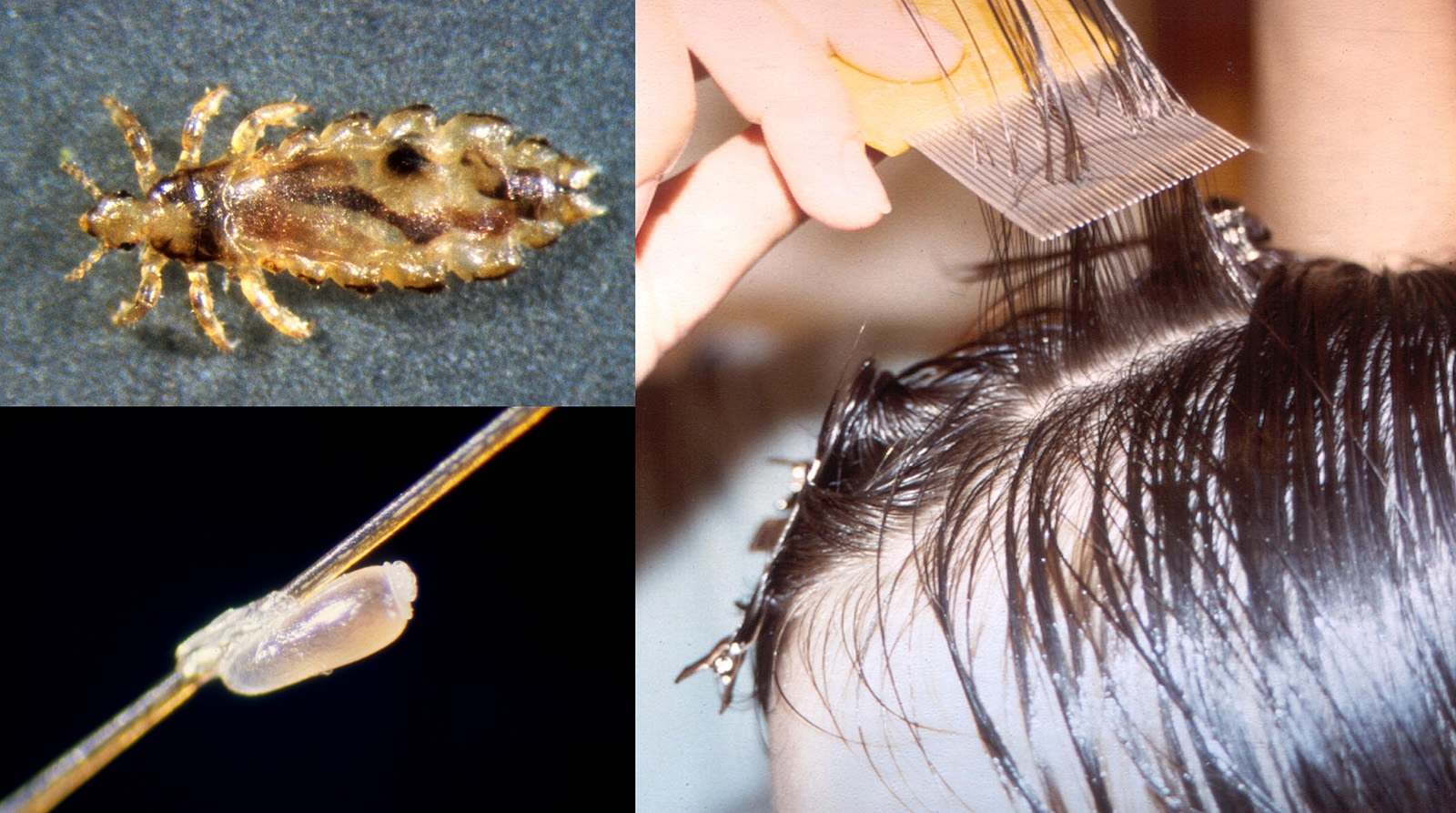 (L-R) Adult louse (highly magnified); Nit (egg) on a strand of hair (highly magnified); Use a nit comb on wet hair. Photos by UNL Entomology and Barb Ogg, Extension Educator, Emeritus 