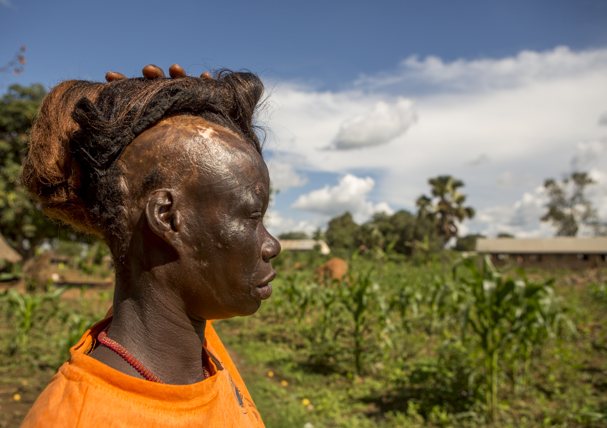 From the Global Eyewitness Uganda trip: Polline Angeyo lifts her wig to reveal scars from the 1995 LRA attack on her home village of Awach in northern Uganda. Photo by Gabriella Parsons. 